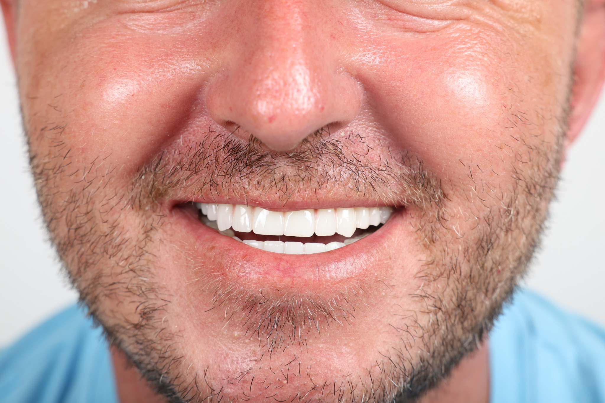 After All-on-6 Implant Treatment